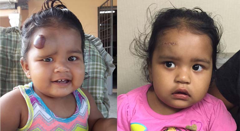 Avani Hakim before and after surgery