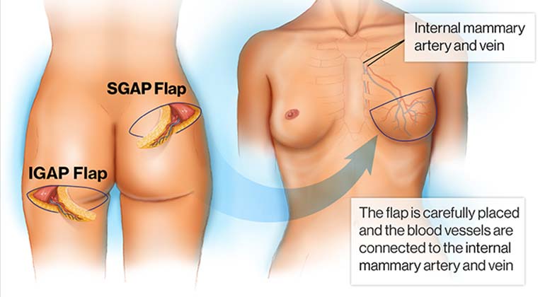 Diagram of Superior and Inferior Gluteal Artery Perforator Flap (SGAP and IGAP) breast reconstruction surgery