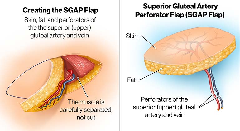 Diagram of Superior and Inferior Gluteal Artery Perforator Flap (SGAP and IGAP) breast reconstruction surgery