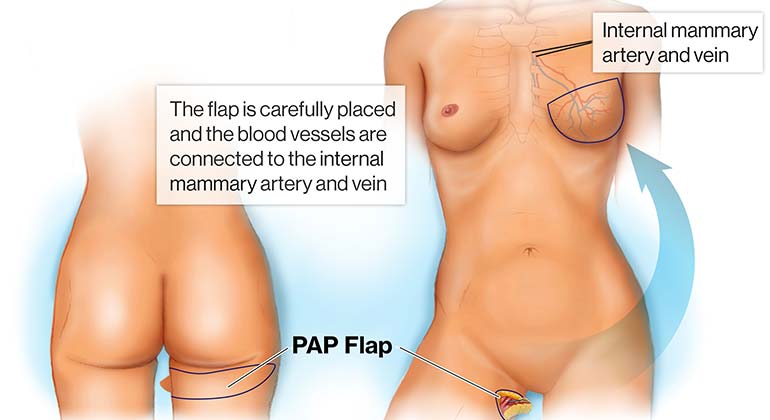 Diagram of Profunda Artery Perforator Flap (PAP) breast reconstruction procedure