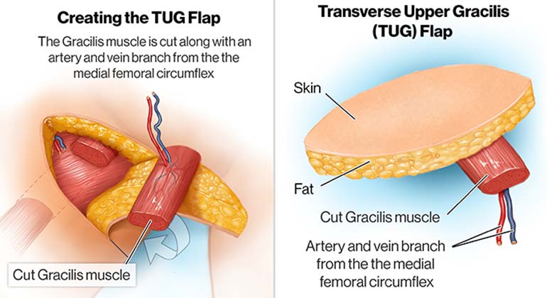 Diagram of Inner Thigh or Transverse Upper Gracillis (TUG) Flap breast reconstruction