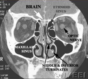 Sinus: Pain, Pressure, Drainage - Ear ... - entassociates.com