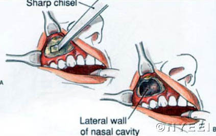 sinusitis operatie