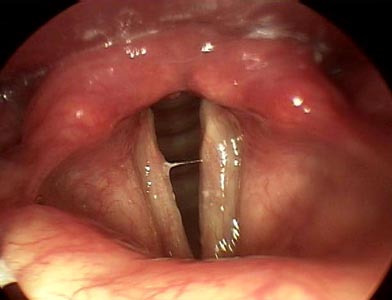 Esophageal Cancer Mucus Production