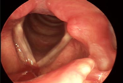 sulcus