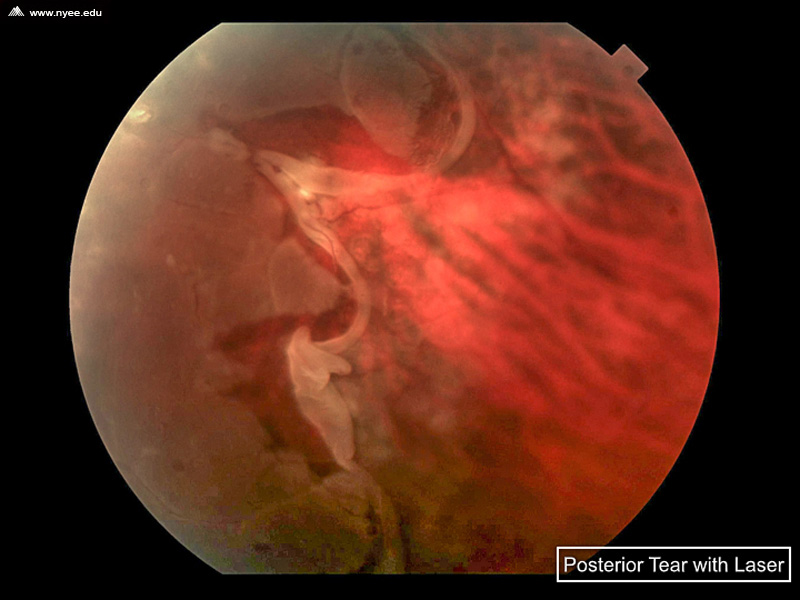 Posterior Retinal Tear (3 of 5) - NYEE