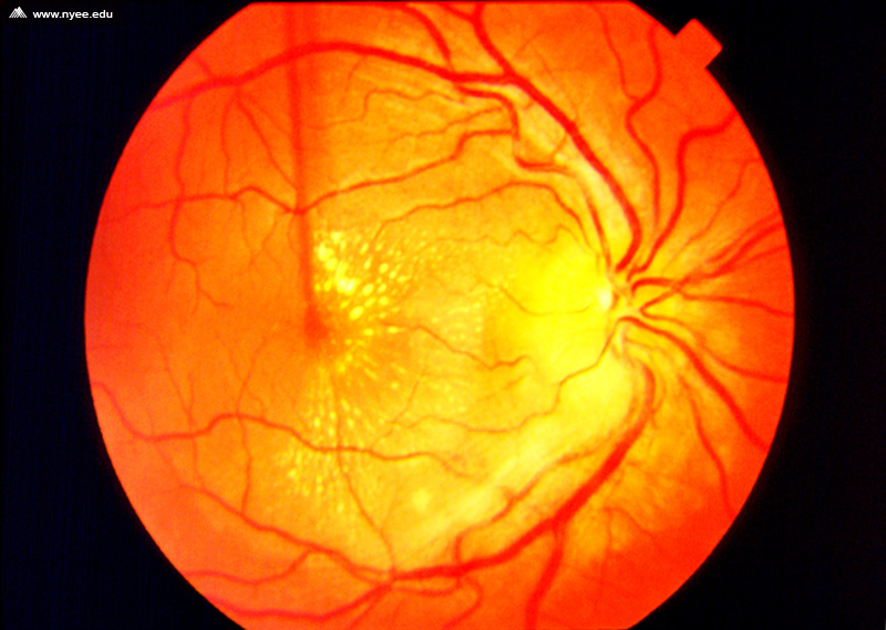 Macular Star - NYEE