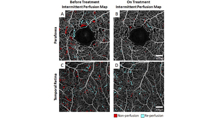 Imaging after two months of hydroxyurea treatment