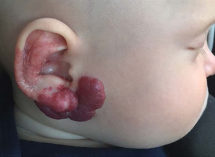 Photo of Image of baby with birthmark on his right ear