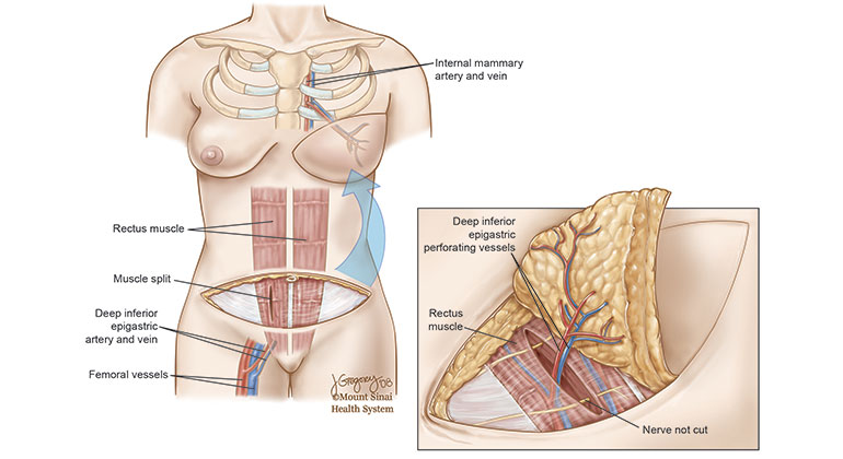 Diagram of Deep Inferior Epigastric Perforator Flap (DIEP flap) breast reconstruction procedure