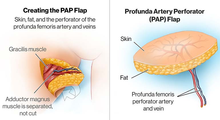 Diagram of Profunda Artery Perforator Flap (PAP) breast reconstruction procedure