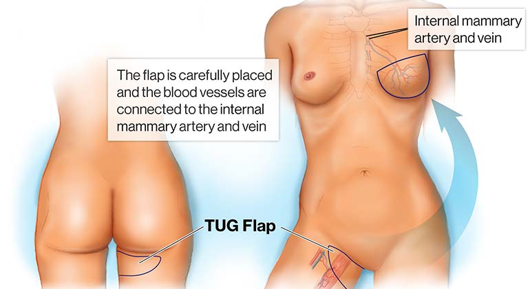 Diagram of Inner Thigh or Transverse Upper Gracillis (TUG) Flap breast reconstruction