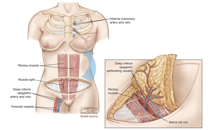 Breast Reconstruction Procedure - DIEP Flap Image Wrapper