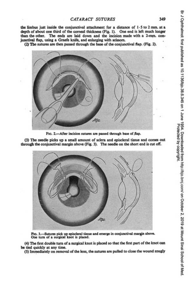 Diagram of Cataract Sutures