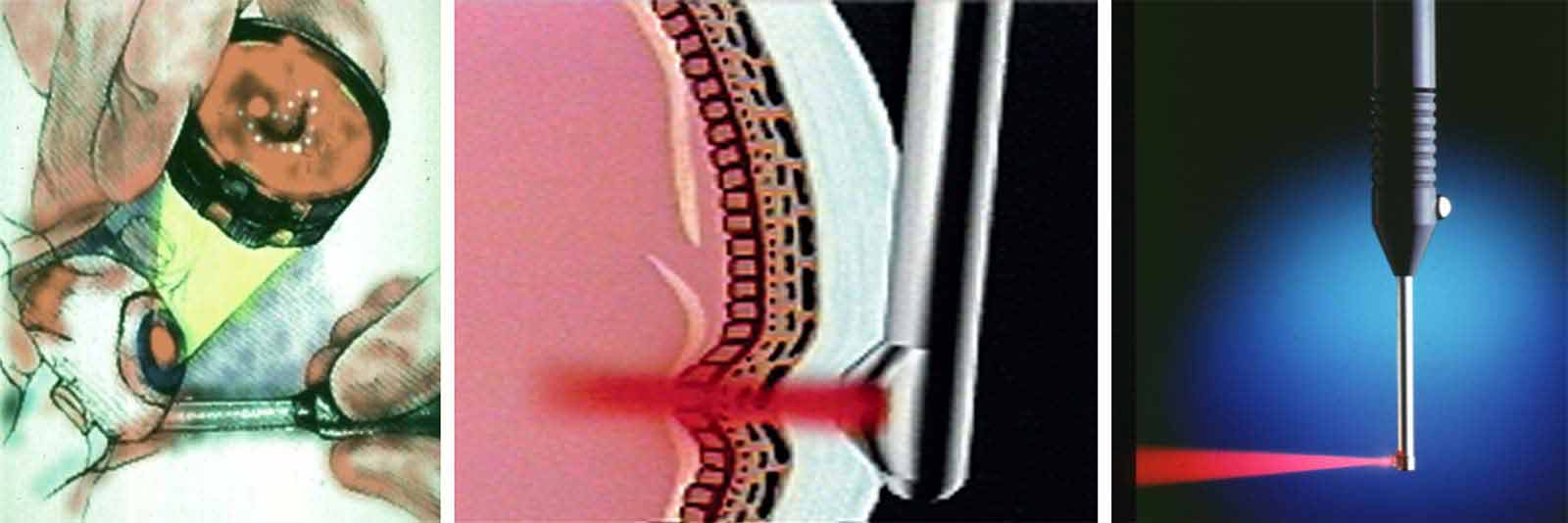 Illustraton of laser probe