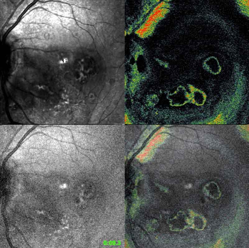Simultaneous multi-channel OCT/SLO/ICG angiography