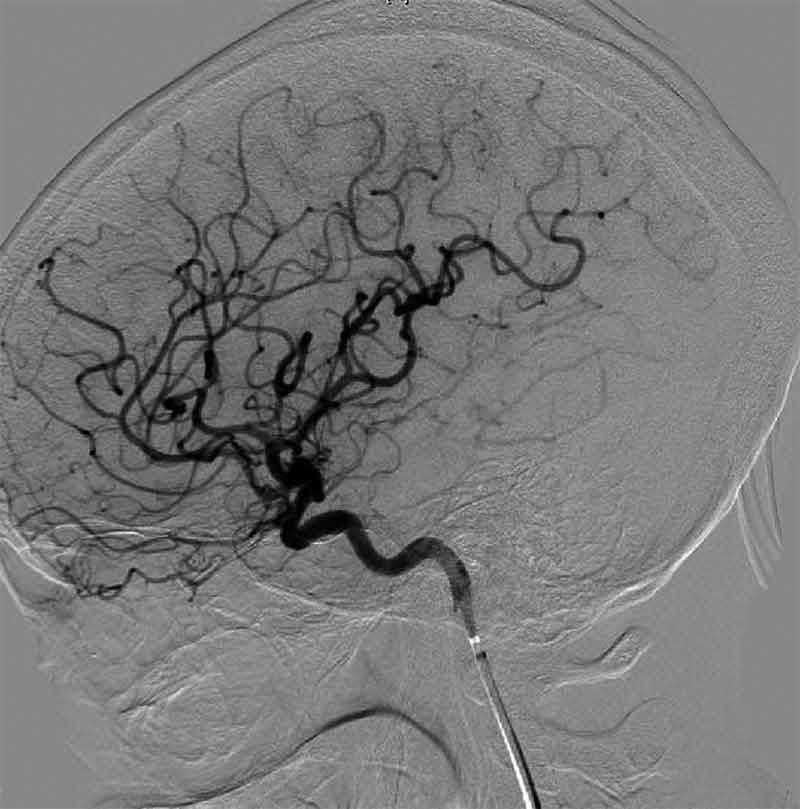 Image of veins in the brain