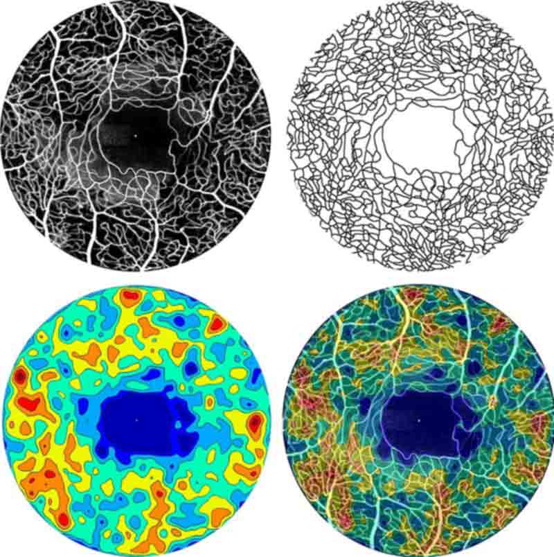 Adaptive optics scanning light ophthalmoscopy with fluorescein angiograph